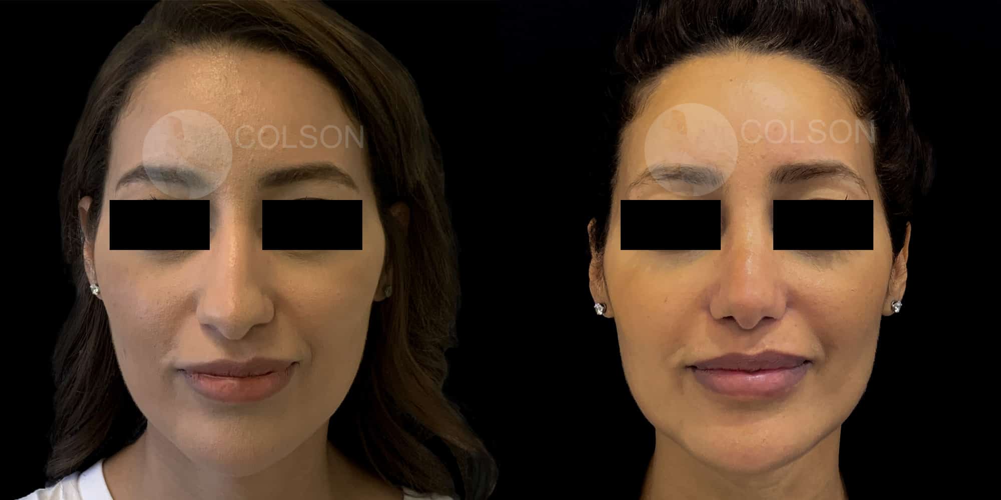Dr Colson - Chirurgie visage - Rhinoplastie Face