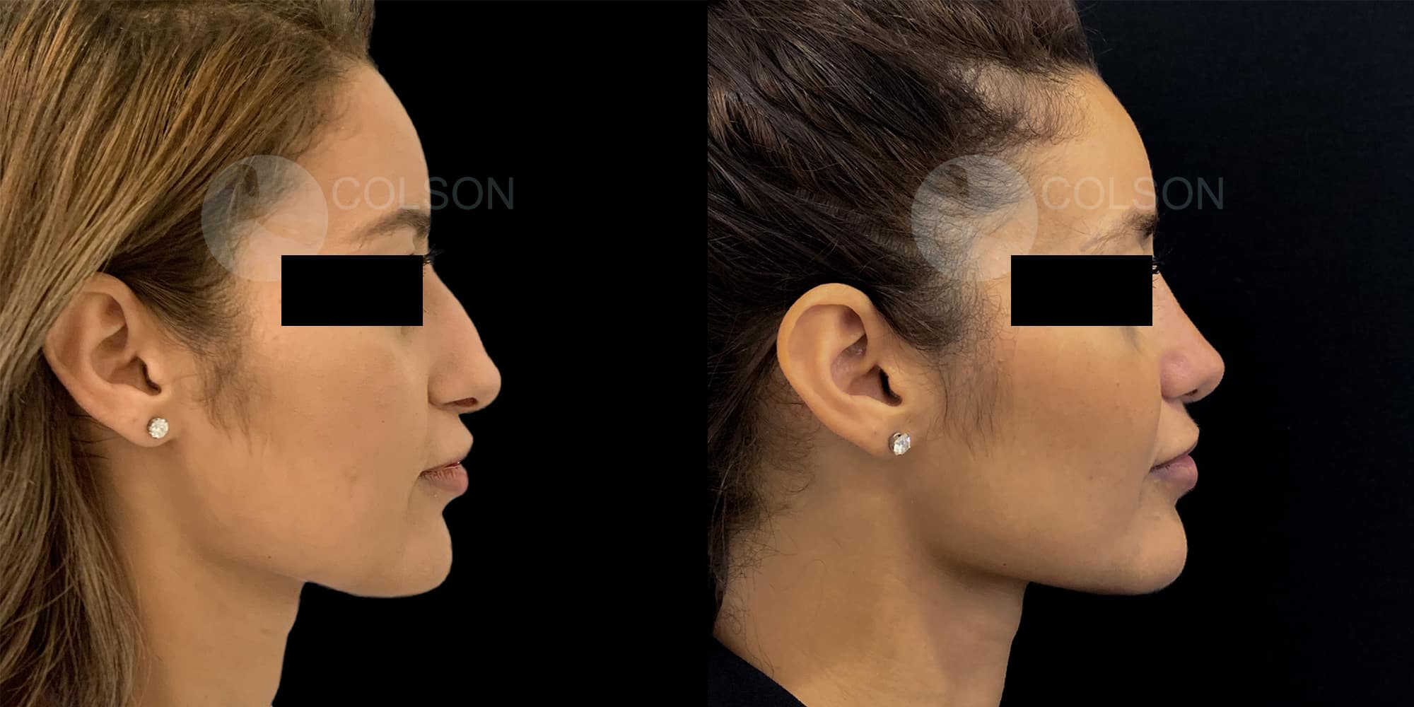 Dr Colson - Chirurgie visage - Rhinoplastie Profil
