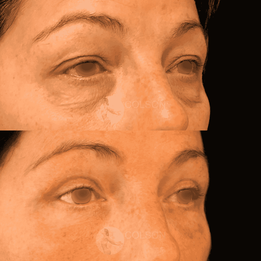 Dr Colson - Chirurgie visage - Blepharoplastie Superieure Inferieure Trois Quart