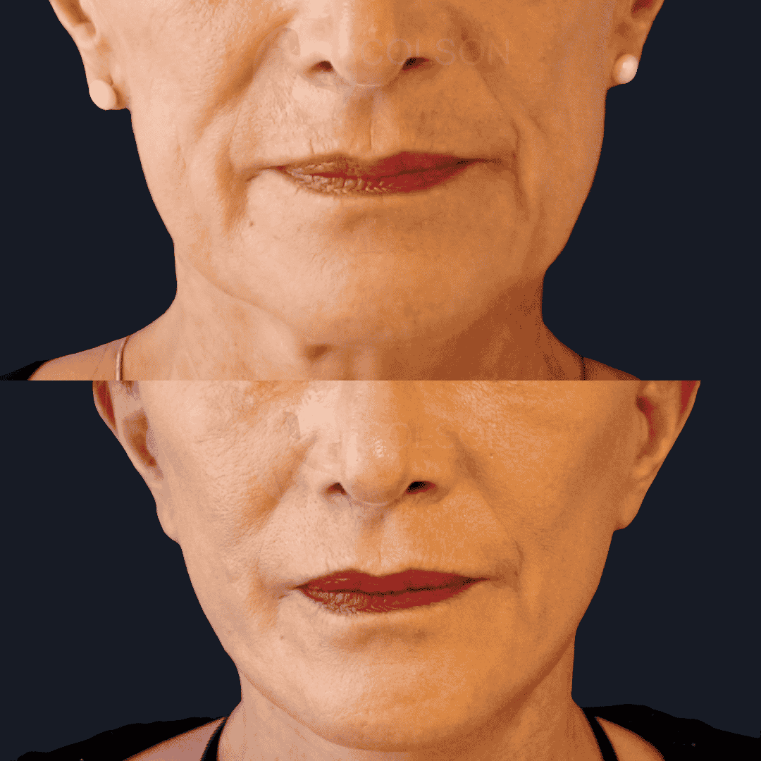 Dr Colson - Chirurgie visage - Lifting Visage Face