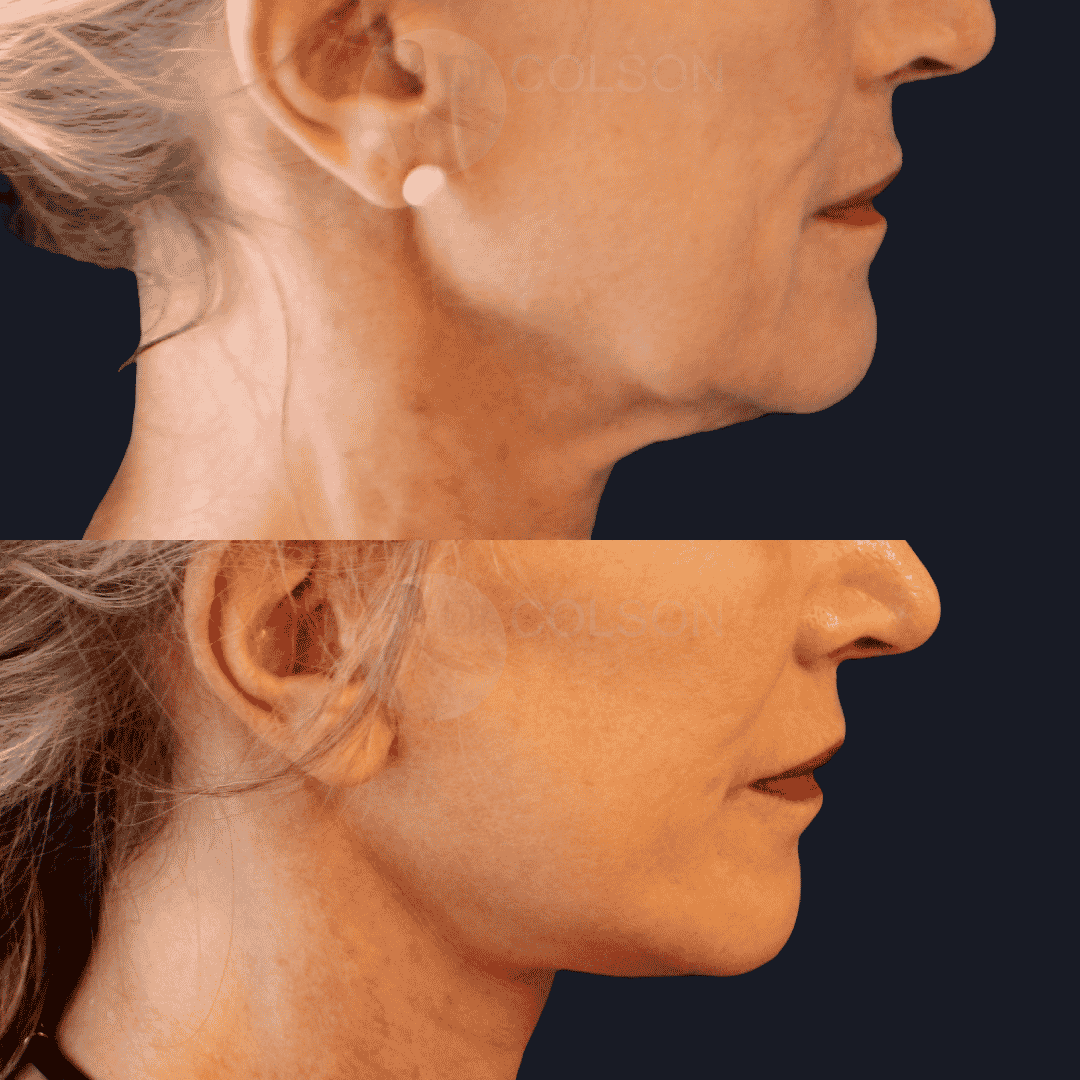 Dr Colson - Chirurgie visage - Lifting Visage Profil