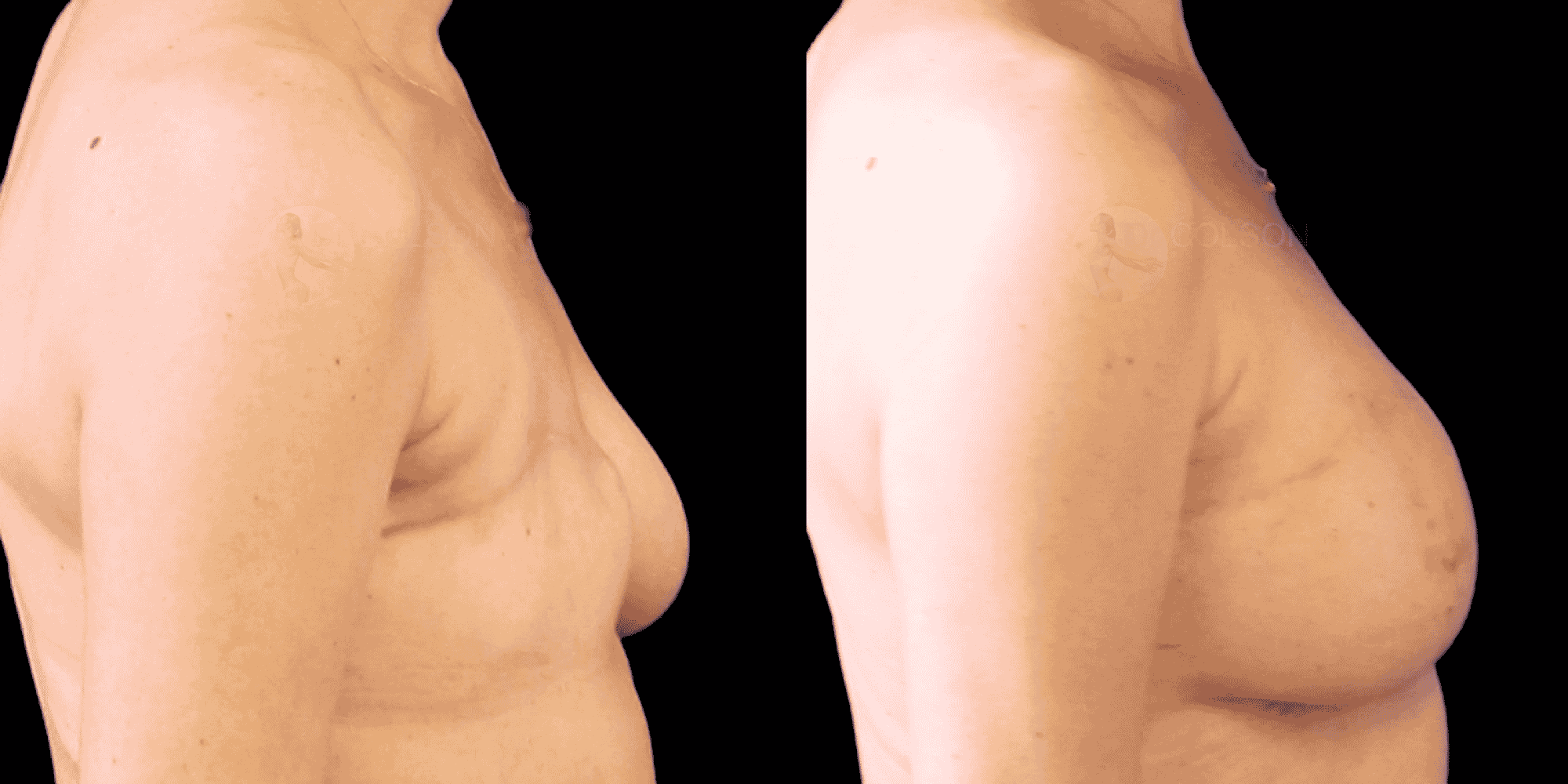 Dr Colson - Chirurgie sein - Reconstruction Mammaire Par Lipofilling Profil