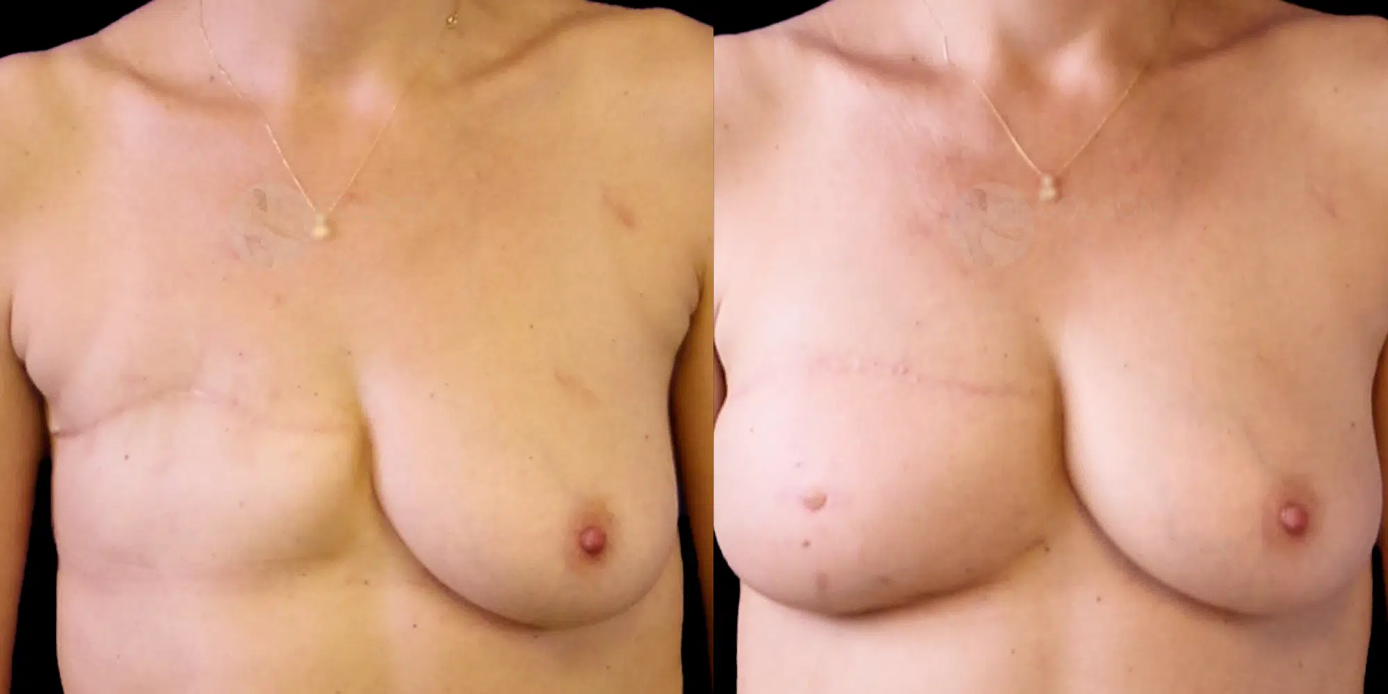 Dr Colson - Chirurgie sein - Reconstruction Mammaire par Lipofilling Face