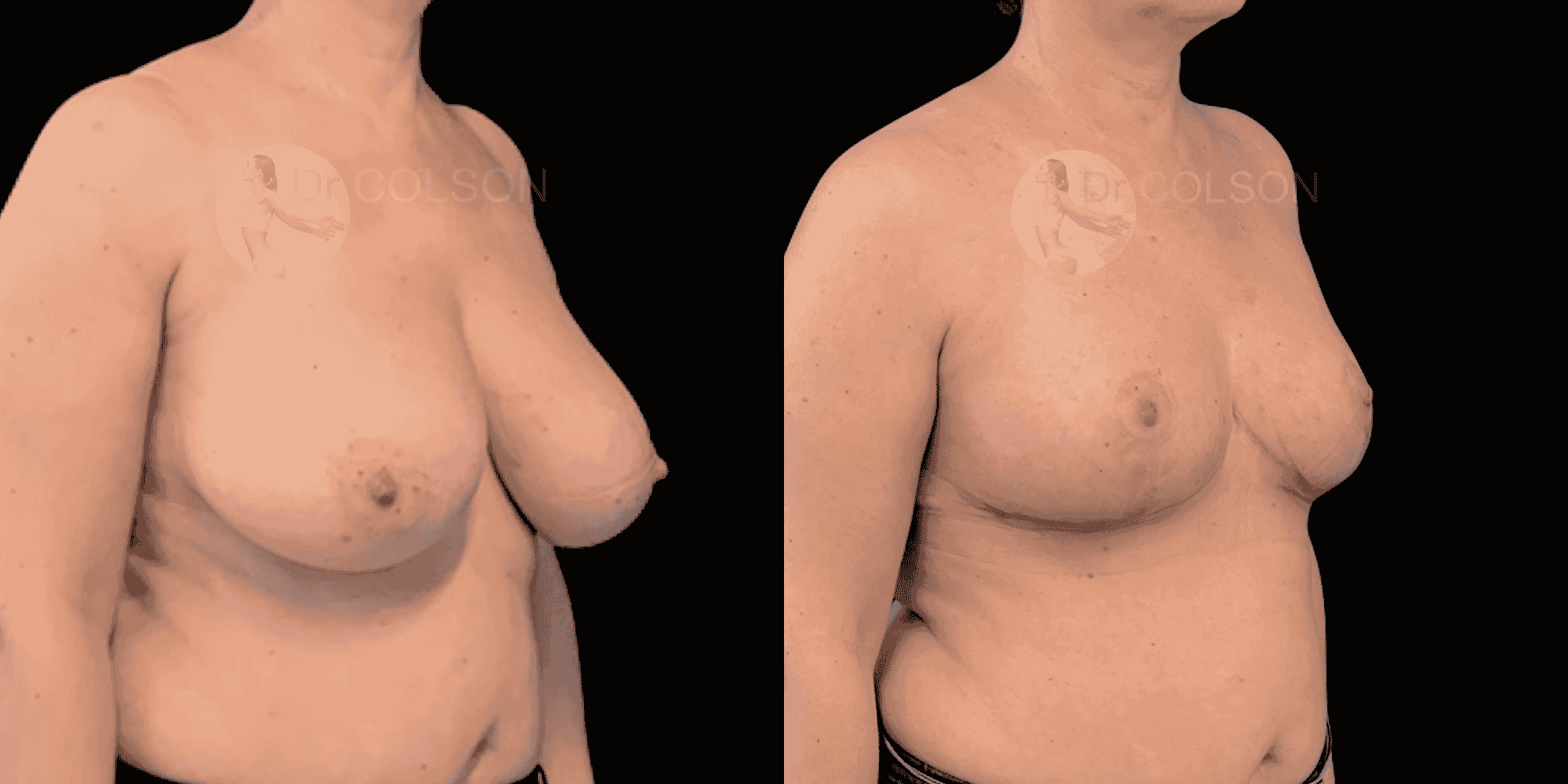 Dr Colson - Chirurgie sein - Reduction Mammaire Trois Quart